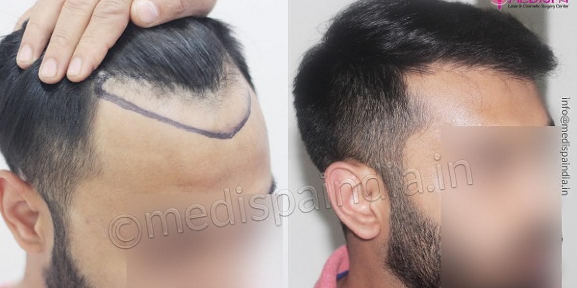 How To Get Cost Efficient Hair Transplant Treatment?