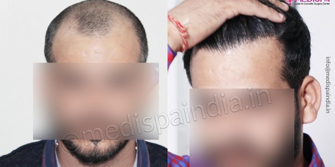 Explain The Stages of Baldness And How Hair Transplant Can Help?