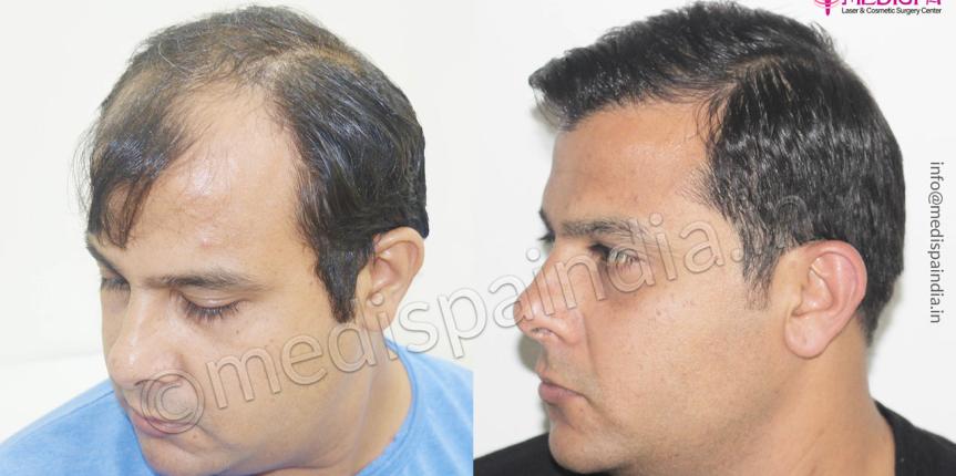 hair transplant cost in bhubhneshwar