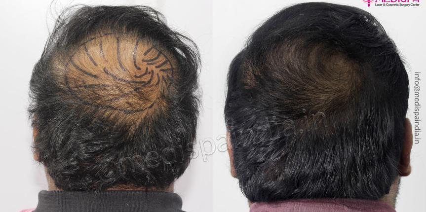 Hair Transplant India results