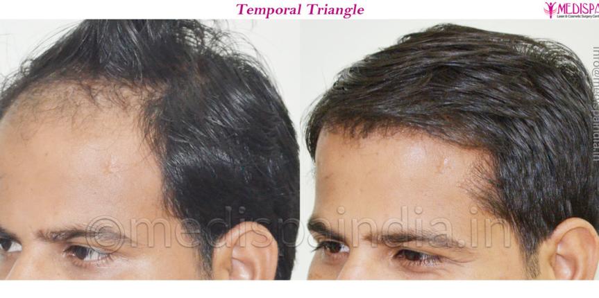 hair transplant in noida