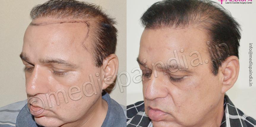 bad hair transplant repair delhi