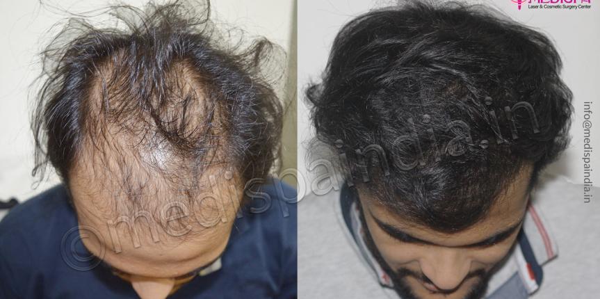 hair transplant cost in new-zealand