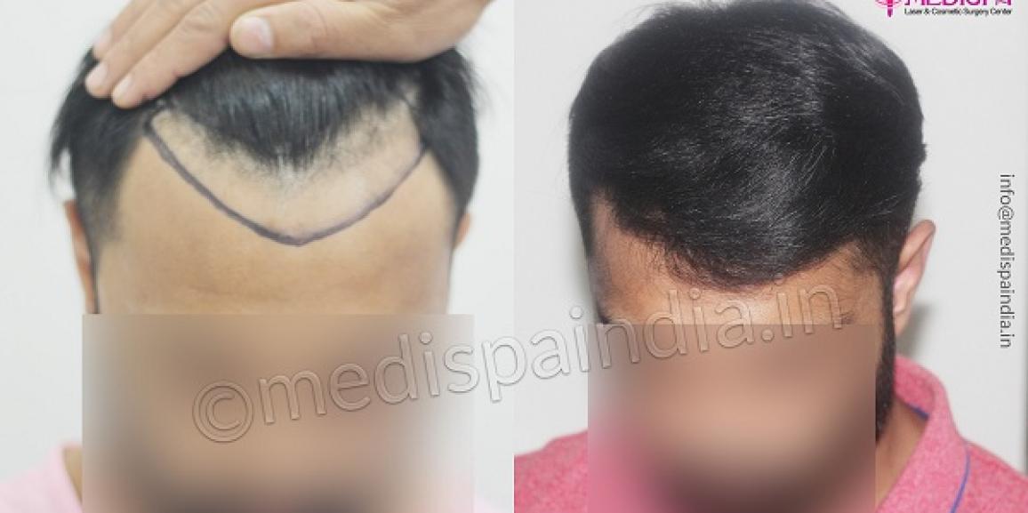 What Are The Precautions Need To Be Taken Pre And Post Hair Transplant?