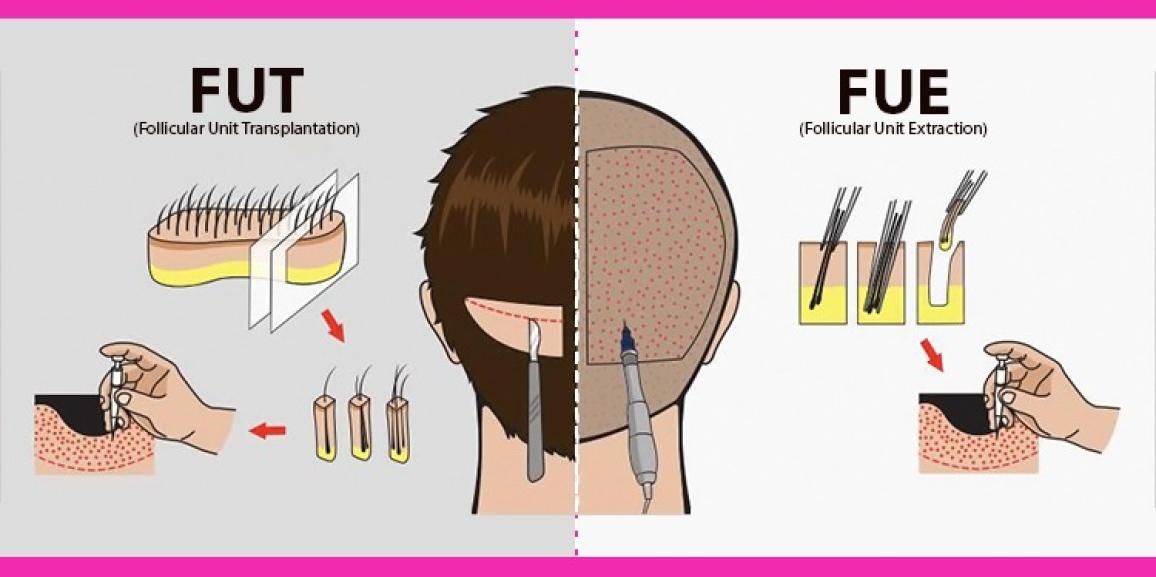 Hair Transplantation Techniques: FUE VS FUT