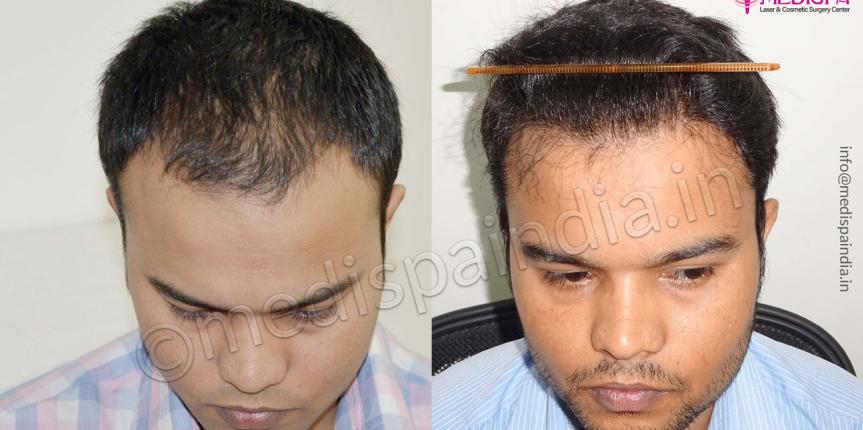 male hair transplant results