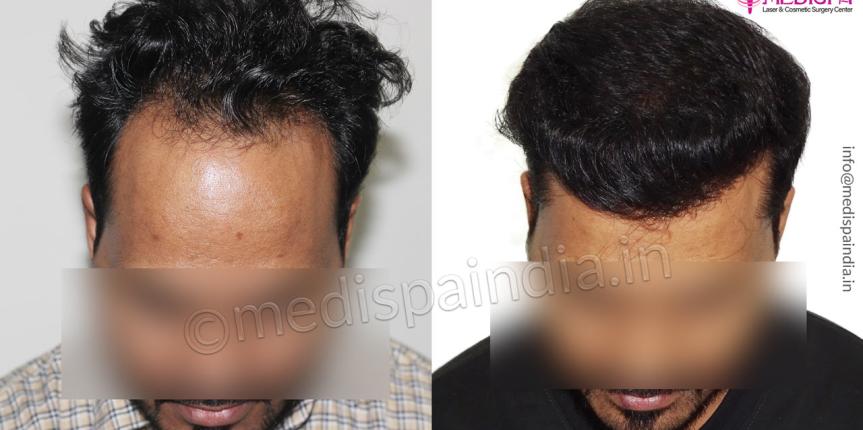 hair-transplant-delhi-results-india