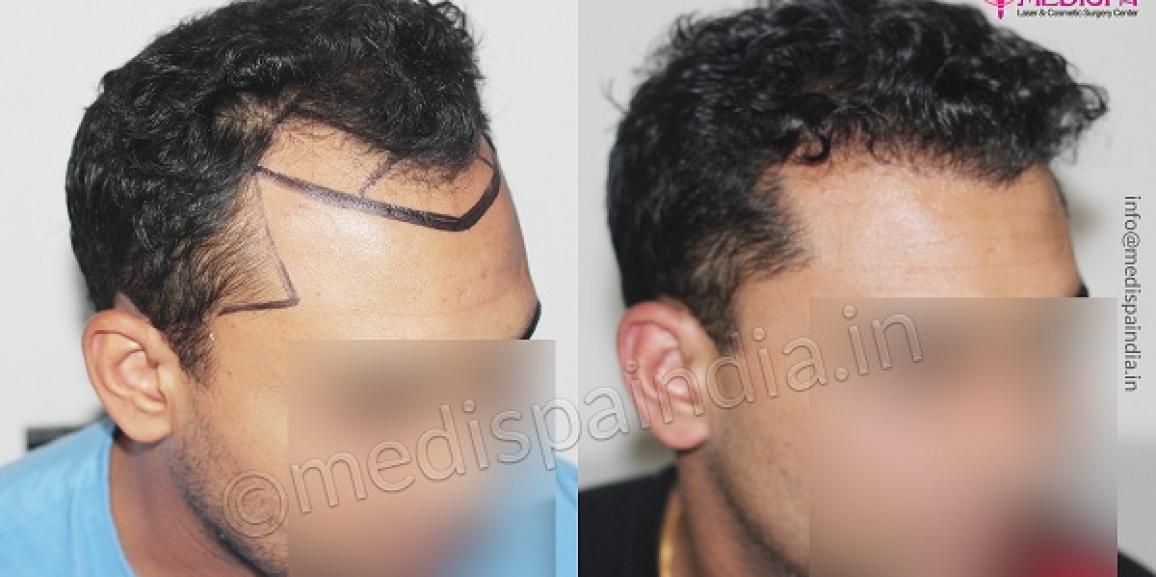 What Are The Factors To Be Considered Before Hair Transplant Surgery?