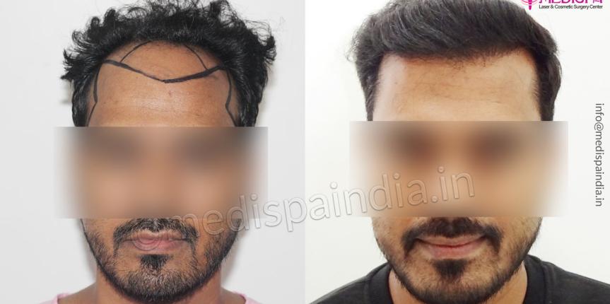 hair transplant Lucknow
