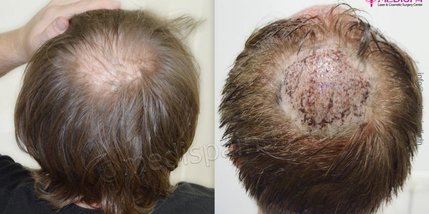 usa hair transplant results