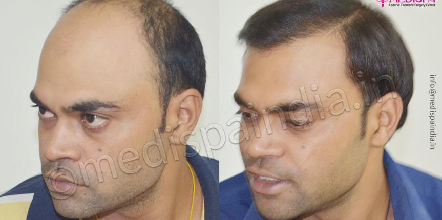 hair restoration cost in jaipur rajasthan