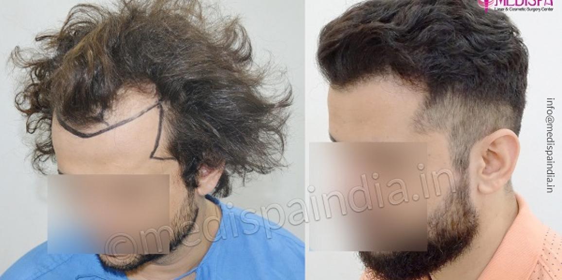 Significant Factors Which Help To Get Cost-Effective Hair Transplant Surgery
