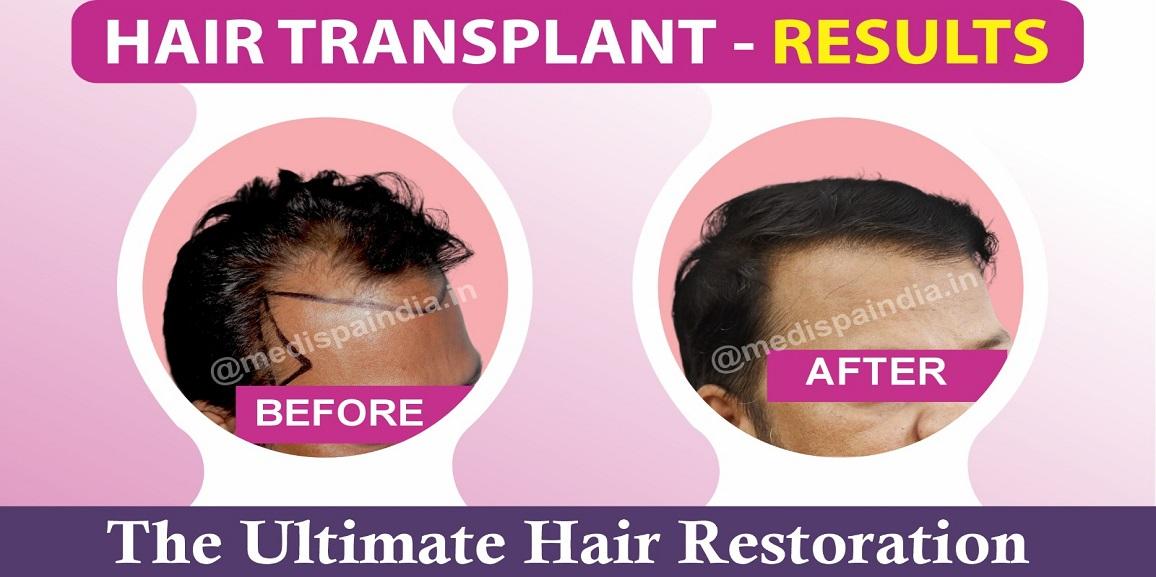 How Can Hair Transplant Help In Improving Hair Density?