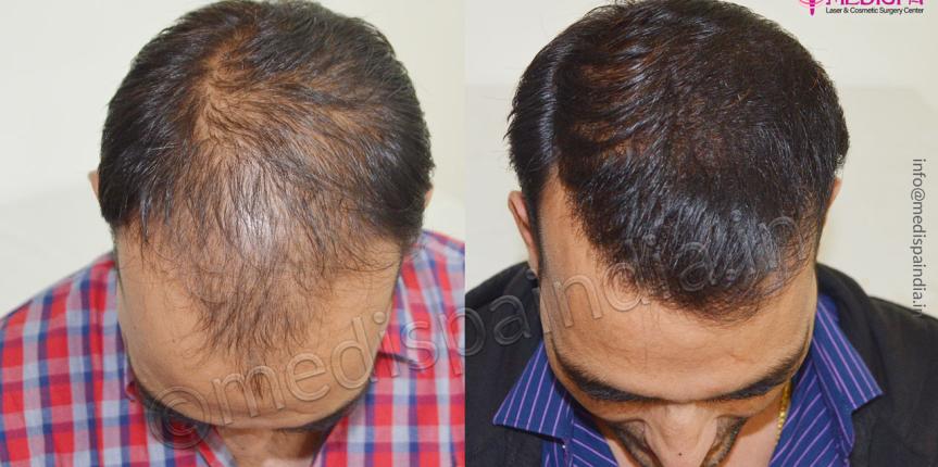 hair transplant cost in jodhpur rajasthan