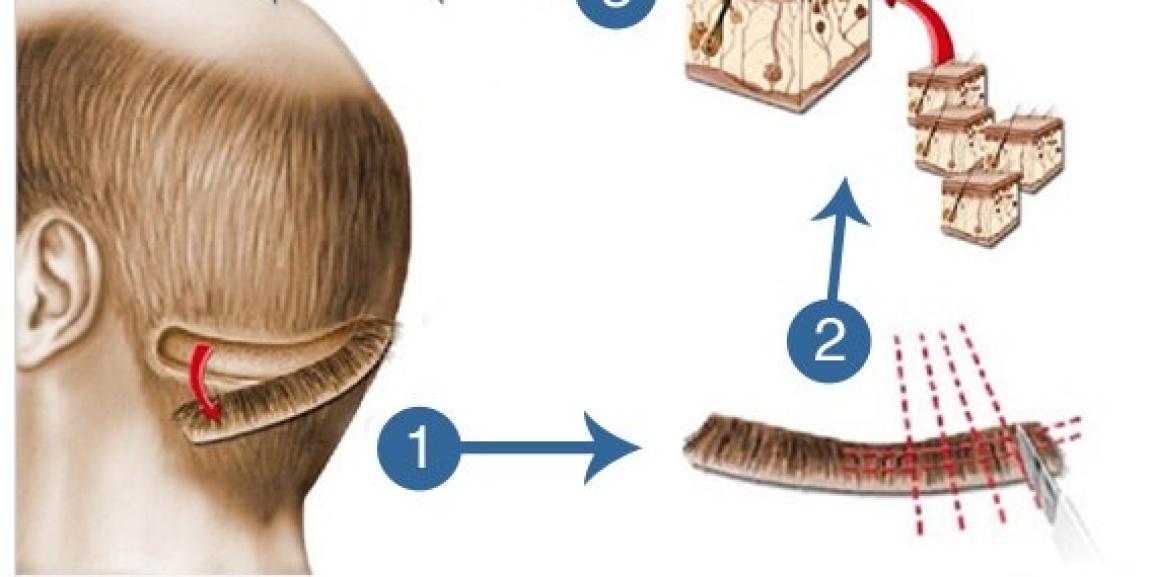 When Should You Choose FUT Method For Hair Transplant?