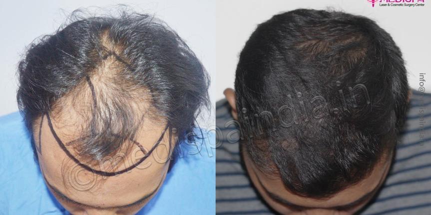 fue hair transplant india
