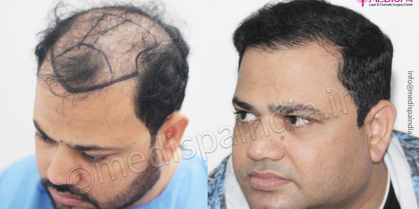 hair transplant cost in hyderabad