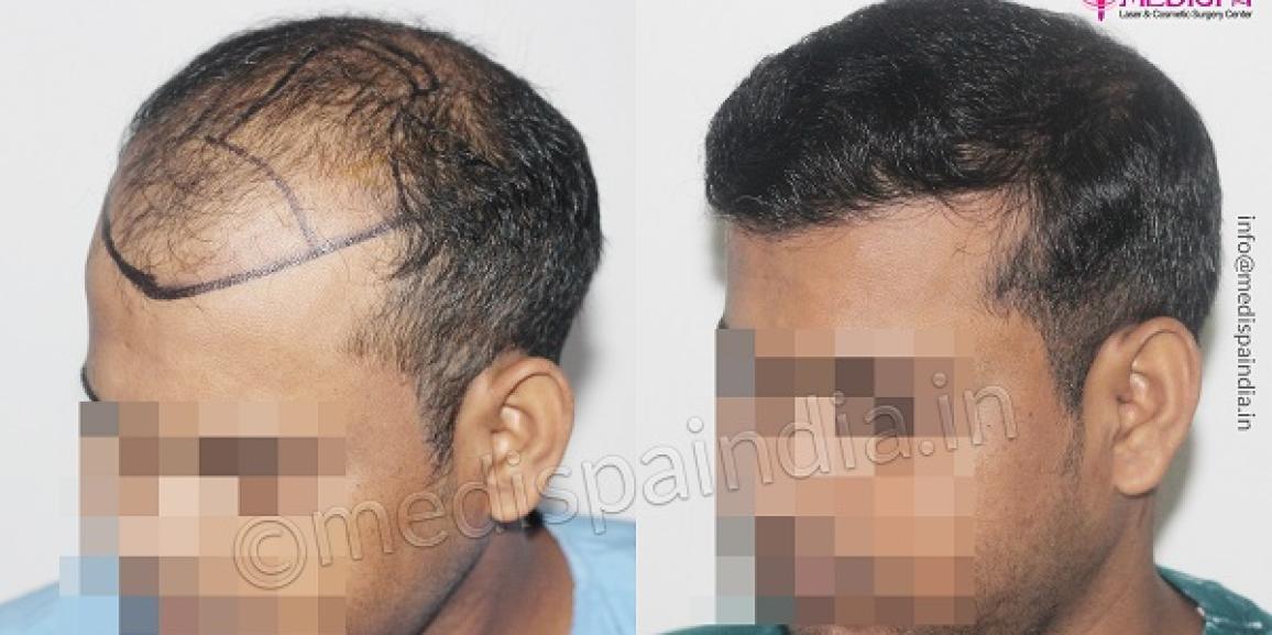 How to Identify The Best Surgeon For Hair Transplant Surgery?