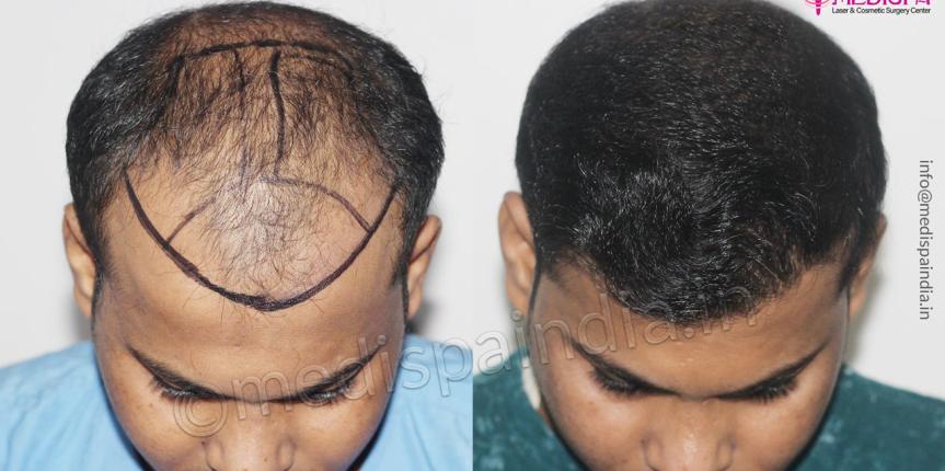 hair restoration jaipur rajasthan india