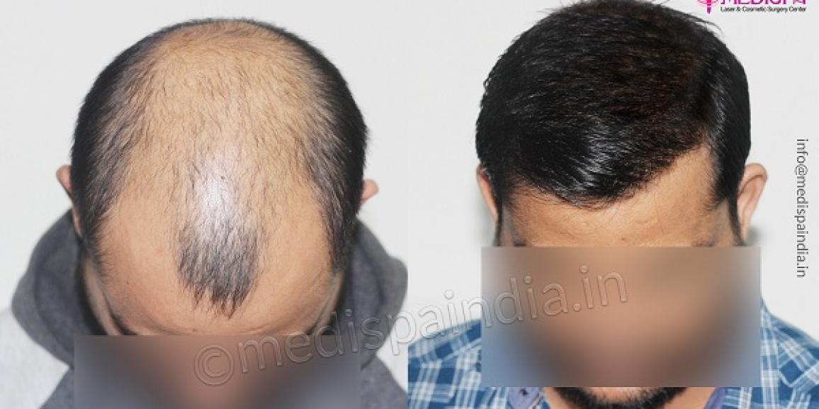 How To Know About Grade of Baldness And How Hair Transplant Can Help?