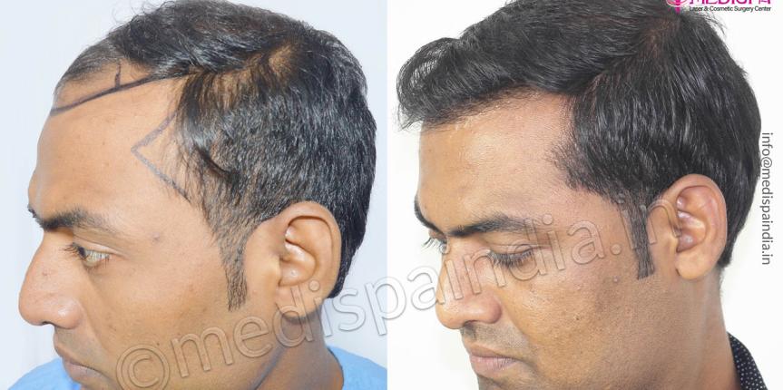 fut fue hair transplant jaipur india
