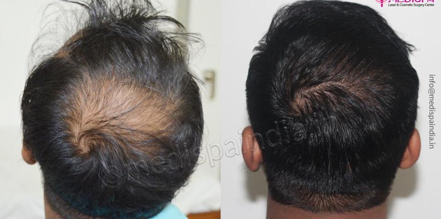 Hair Transplant Delhi after before