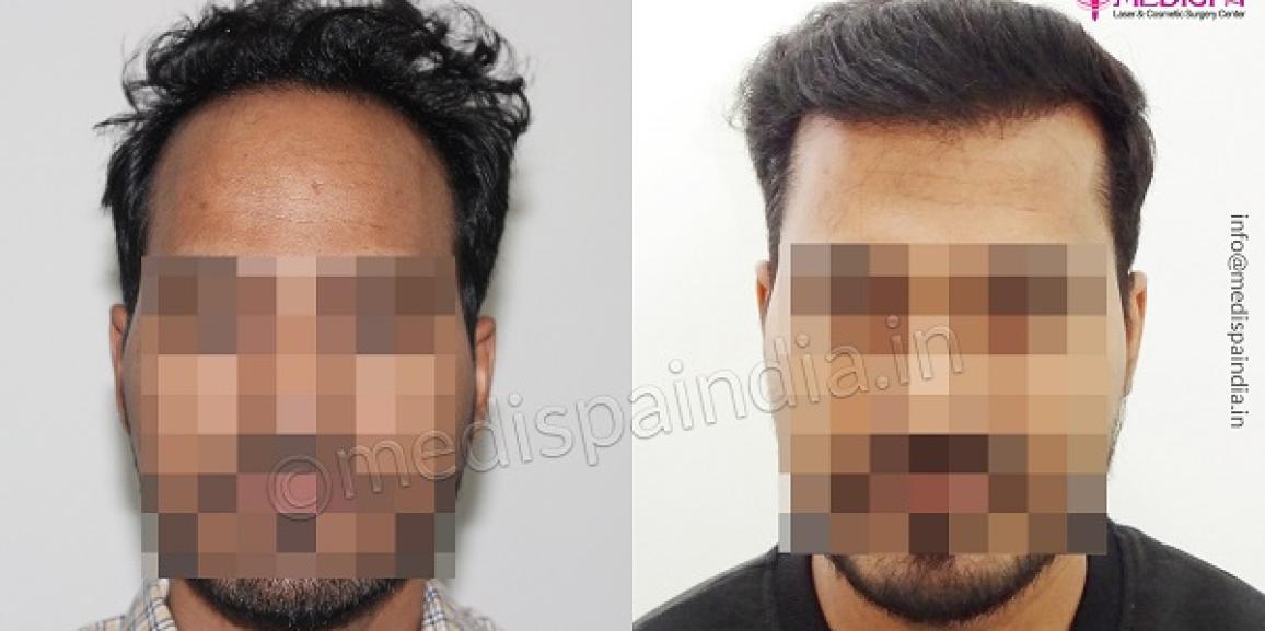 Is Hair Transplantation The Best Treatment For Hair Loss?