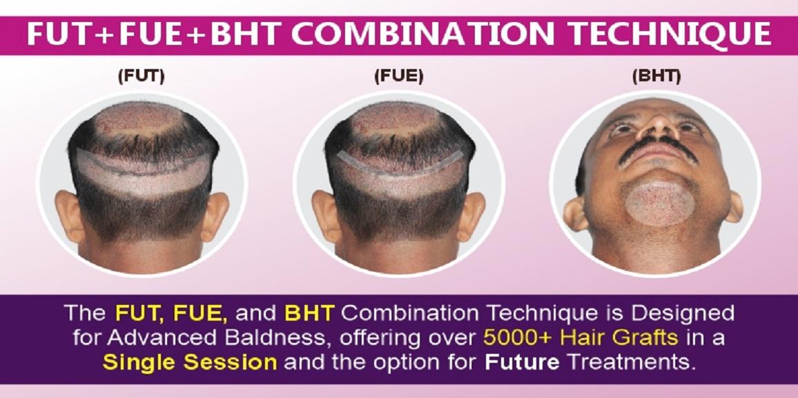 Explain The Benefits of FUT+FUE+BHT Technique For Hair Transplant