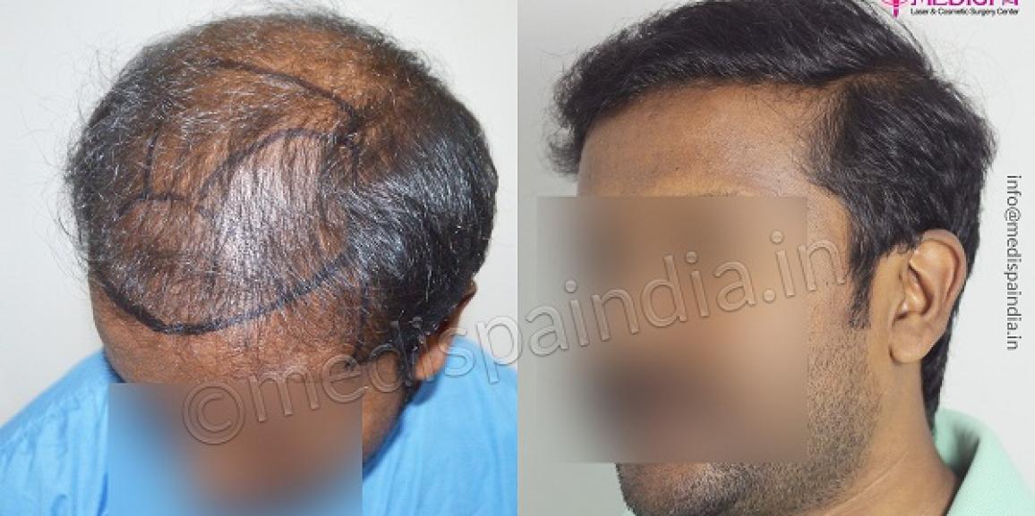 Explain The Importance And Types of Hair Transplant Methods