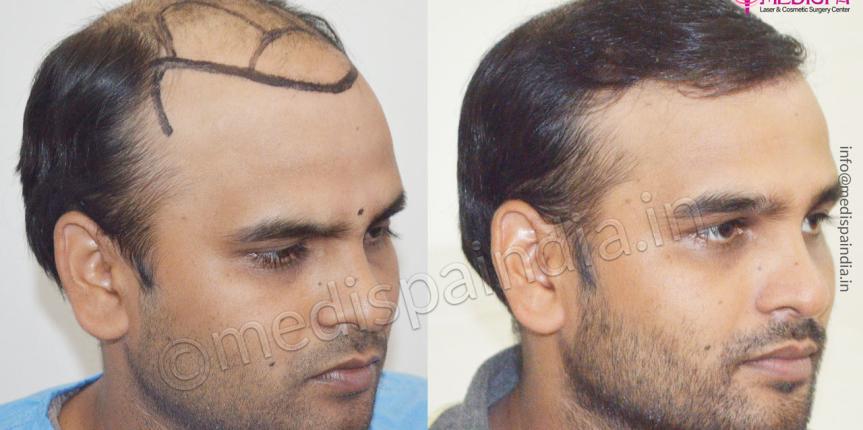 best hair transplant surgeons in ahmedabad