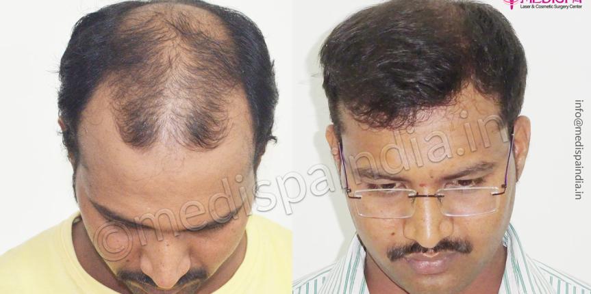 hair transplant cost in cananda