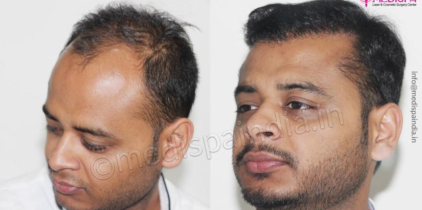 hair transplant results after 12 months