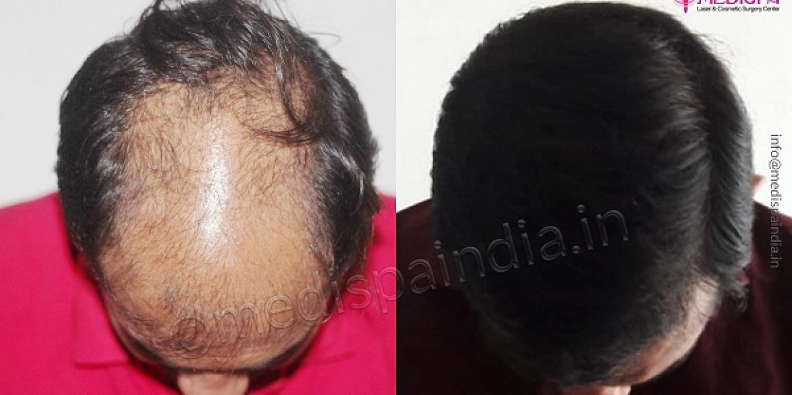Hair Transplant:  The permanent solution for pattern baldness