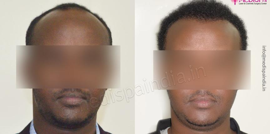 hair transplant in africans