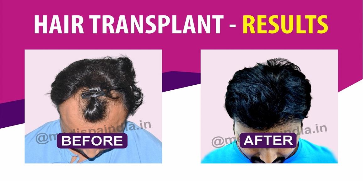 How To Speed Up Hair Growth After Hair Restoration?