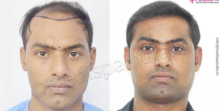 fut fue hair transplant india