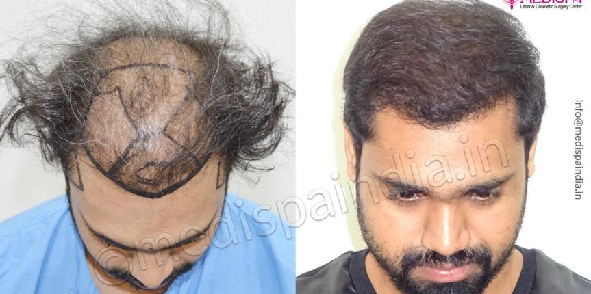 hair transplant mumbai cost