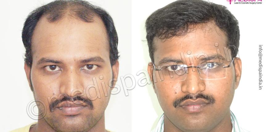 hair transplant cost bangalore india