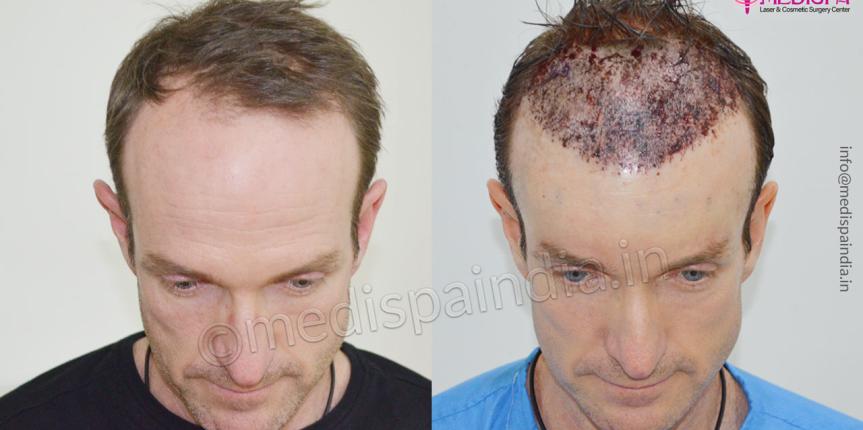 hair transplant in australia