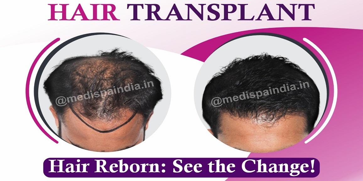 Hair Restoration: A Life-Changing Experience