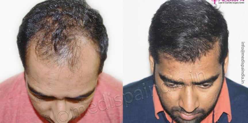 best hair transplant surgeons delhi india