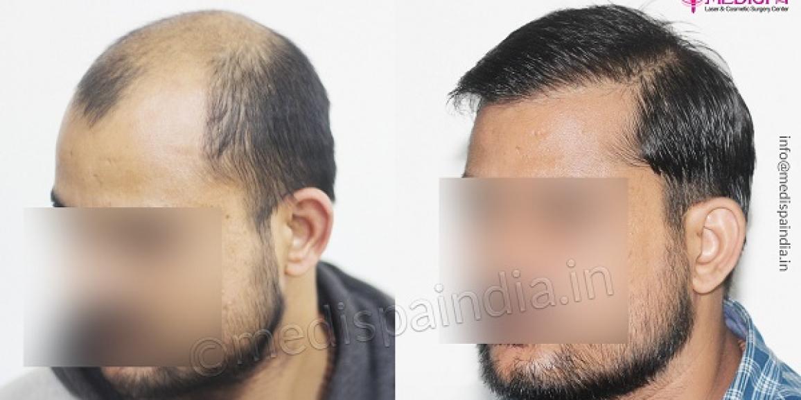 Can Hair Transplant Help in Curing Alopecia Areata?