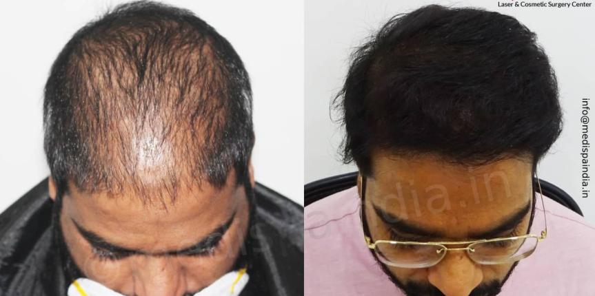 hair transplant cost in mumbai