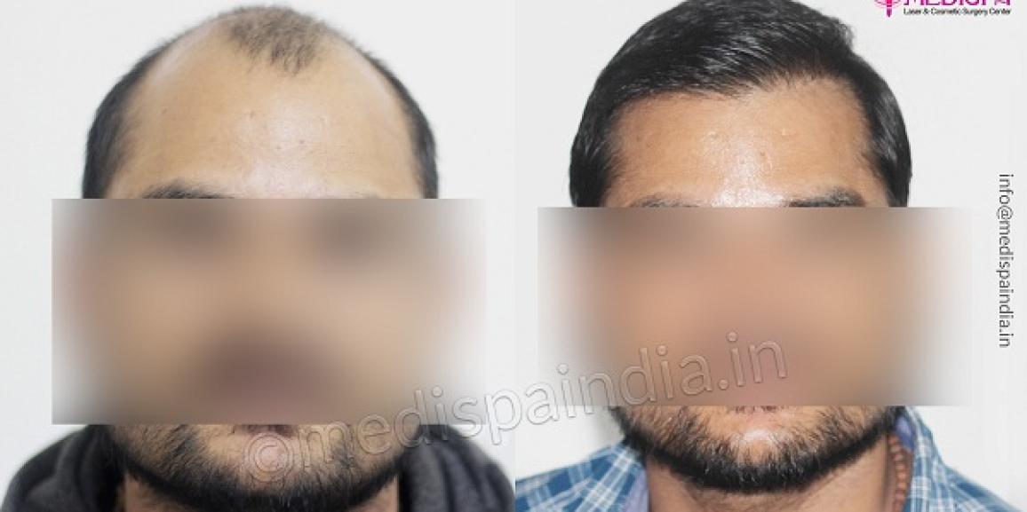 How To Know if Hair Transplantation is Suitable For Me?