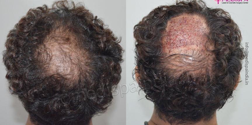 hair transplant results malaysia
