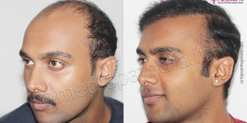 hair transplant cost india