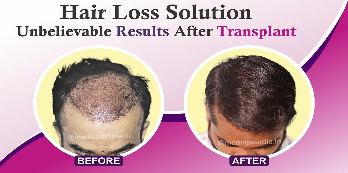 How To Get Natural Hairline And Growth By Hair Restoration?