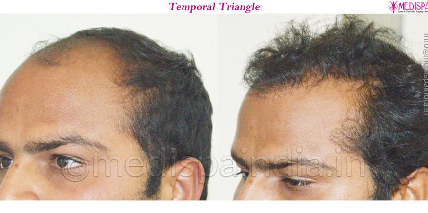 hair transplant clinics in greater kailash delhi