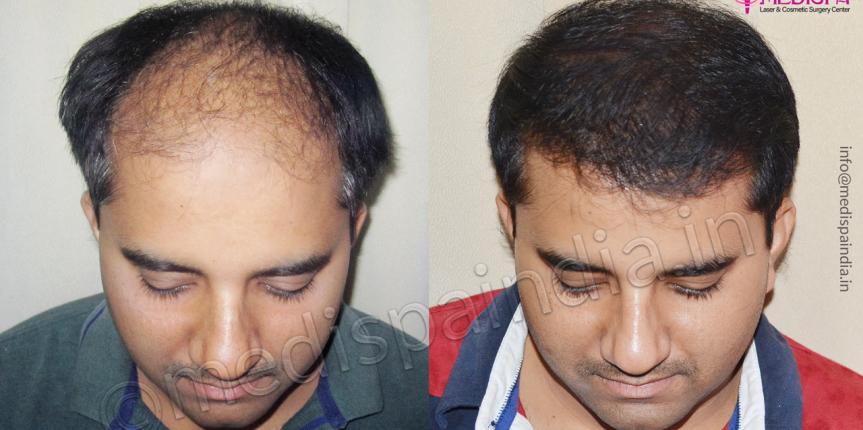 hair transplant clinics in turkey for repair hair transplant clinics in turkey for repair