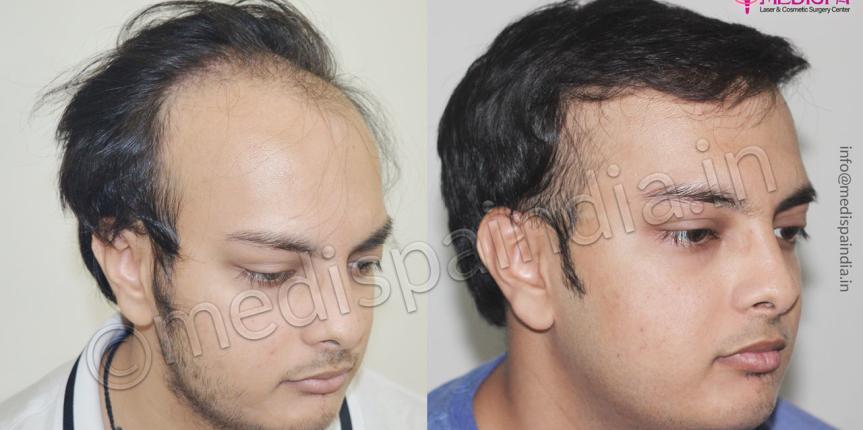 hair transplant surgeons in jodhpur